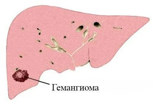 Кавернозная гемангиома макропрепарат. Гемангиома печени макропрепарат. Кавернозная гемангиома печени микропрепарат. Капиллярная ангиома печени.