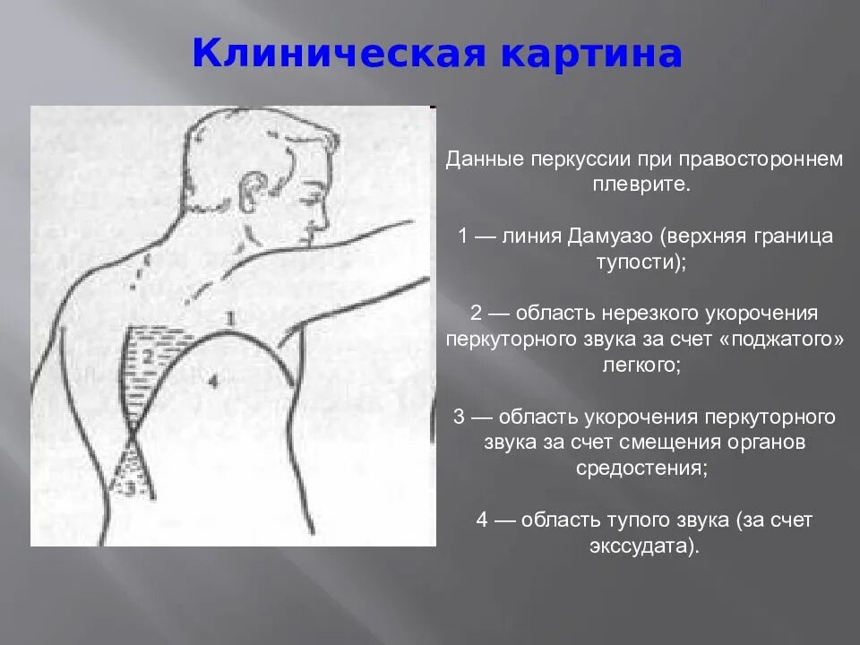 Данные перкуссии сердца в норме. Линия дамуазо. Дилатация правого желудочка перкуссия. Данные перкуссии. Топографическая перкуссия нижних границ легких.
