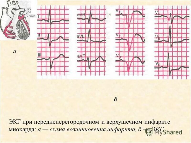 переднеперегородочный инфаркт миокарда на экг