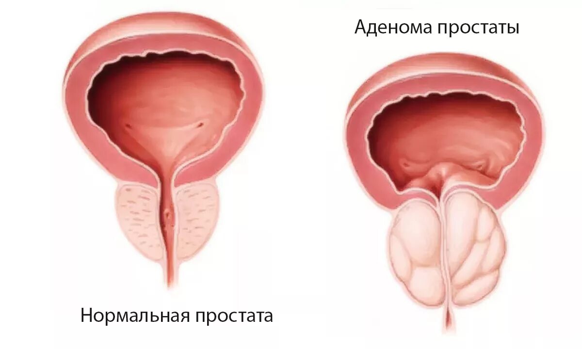 Простата аденома предстательной железы. Аденома предстательной железы (аденома простаты). Доброкачественная гиперплазия предстательной железы. Доброкачественная гиперплазия (аденома) предстательной железы.