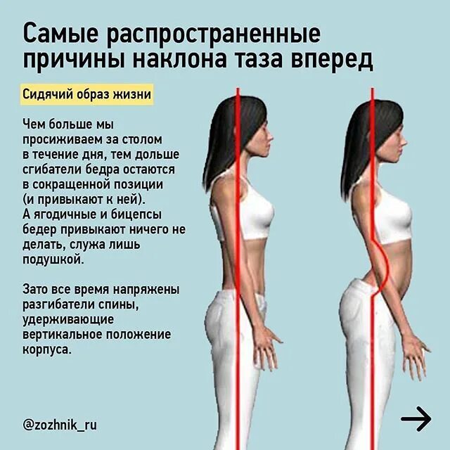 Положение бедер. Мышцы осанки. осанка наклон таза назад. нейтральное положение поясницы. наклон таза вперед.