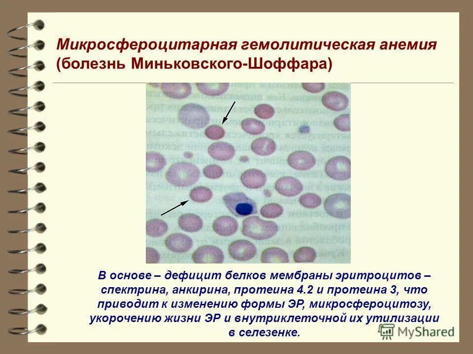 Анемия гемолитического типа