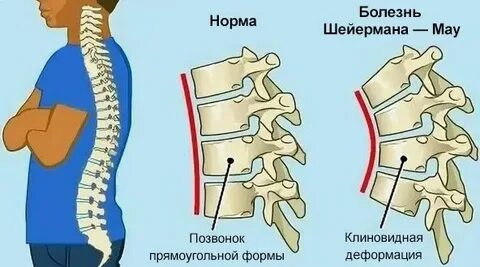 У ребенка клиновидный позвонок