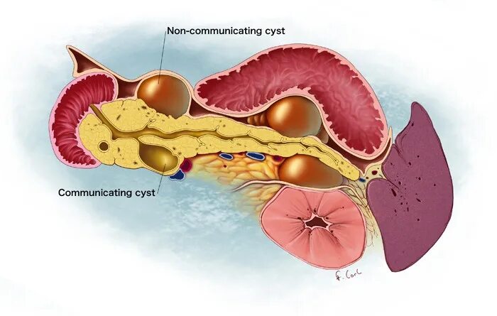 Поджелудочная железа панкреатит операция. Псевдокиста поджелудочной железы. Фистула поджелудочной железы. Кисты и псевдокисты поджелудочной железы. Панкреатический проток псевдокиста.
