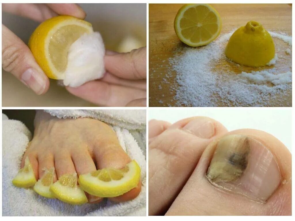 Лимонные ногти на ногах. Можно избавиться от грибка ногтей