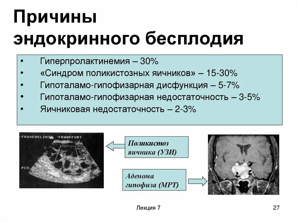 Эндокринное бесплодие. Эндокринное бесплодие диагностика. Эндокринный фактор бесплодия. Гормональная форма бесплодия. Хроническое бесплодие