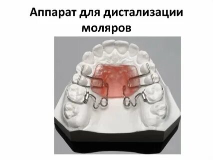 Ортодонтические аппараты механического действия