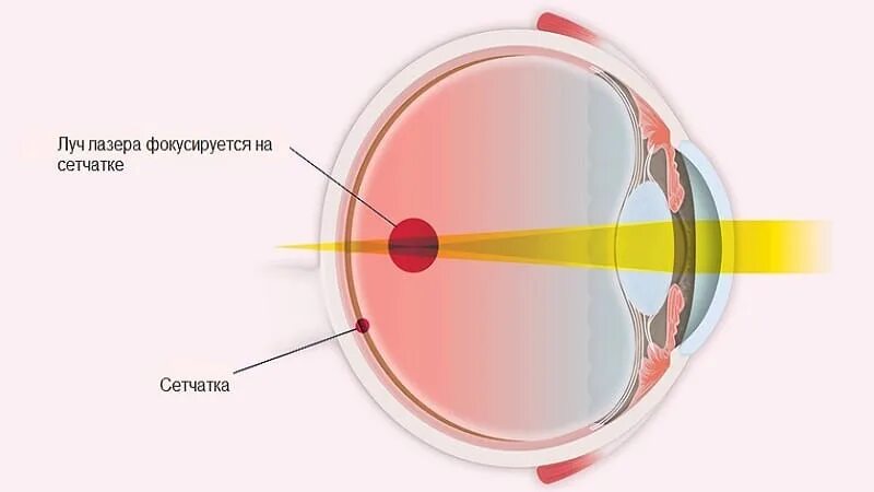 Лазерная коагуляция сетчатки. Отслойка сетчатки лазеркоагуляция. Приваривание сетчатки лазером. Периферическая коагуляция сетчатки.