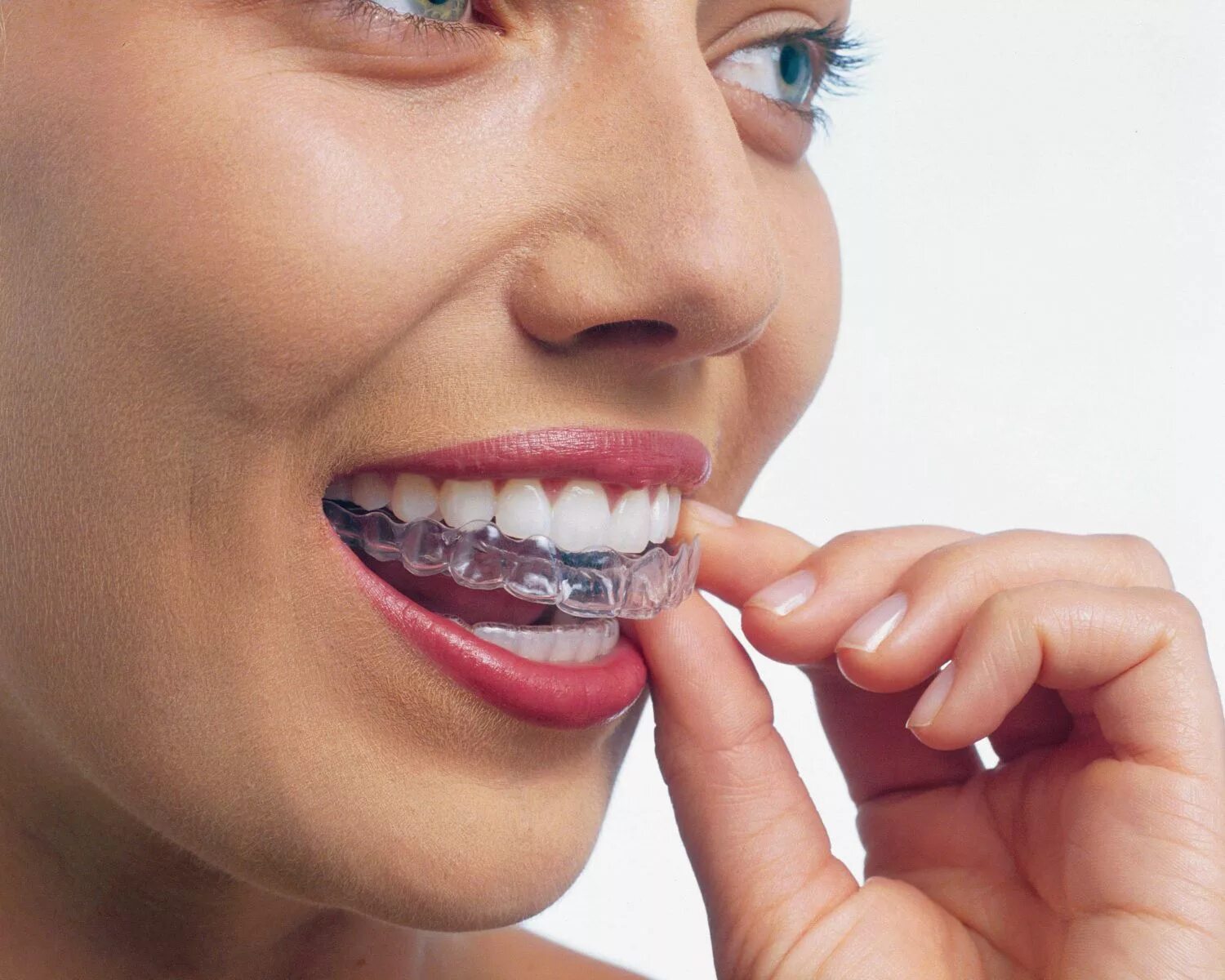 Что такое ортодонт. Каппы Инвизилайн. Элайнеры Invisalign. Каппы элайнеры. Ортодонт каппы элайнеры.