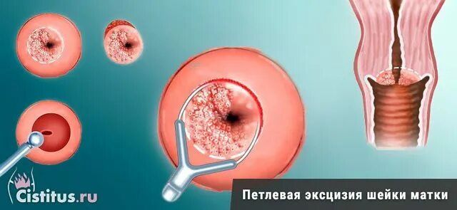 ИЗОБРЕТАТЕЛЬ - сайт журнала " КОМПЛЕКСНОЕ ЛЕЧЕНИЕ РАКА ШЕЙКИ МАТКИ