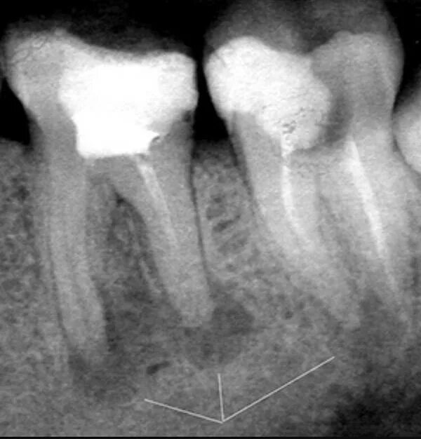 воспаление зуба периодонтит