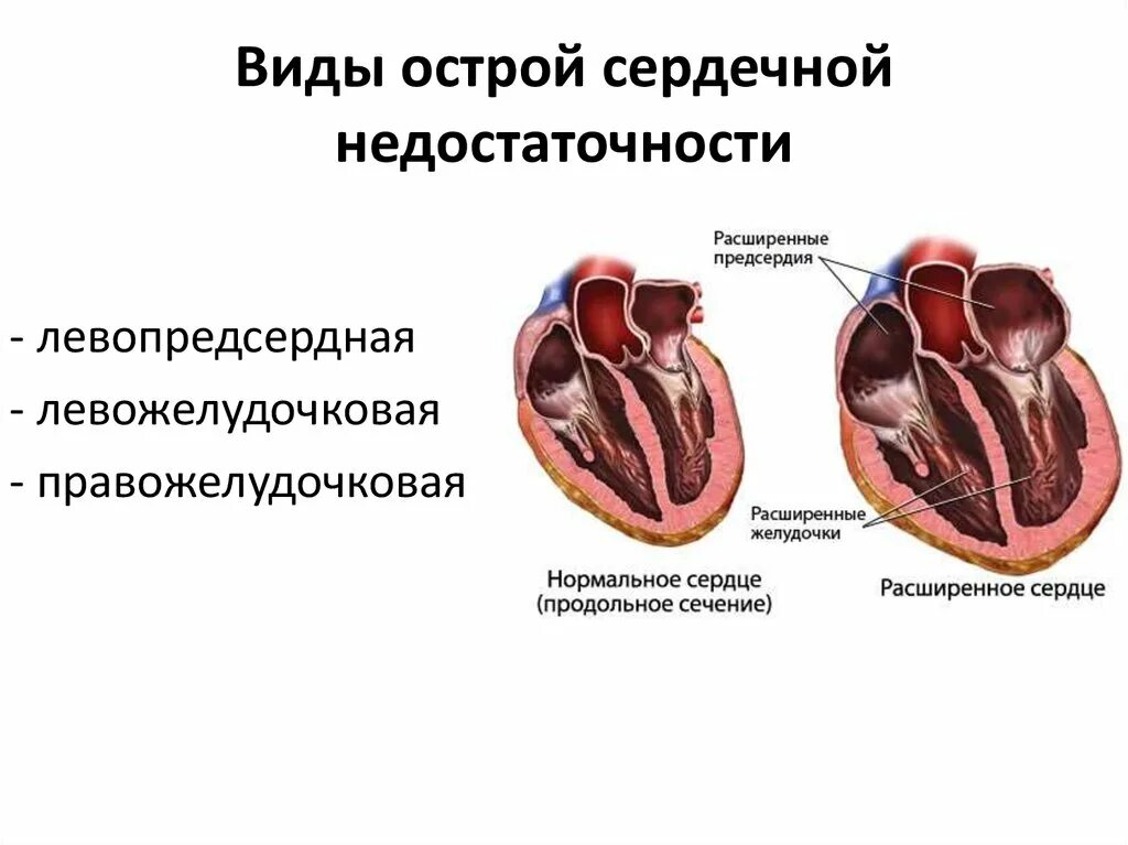 Сосудистая недостаточность виды. Острая сердечная недостаточность симптомы причины. Основные симптомы при острой сердечной недостаточности. ХСН правожелудочковая недостаточность. Острая хроническая недостаточность сердца.