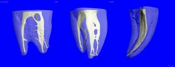 Система корневых каналов зуба. Щелевидная форма корневого канала. Анатомия корневых каналов 3д. Облитерированные корневые каналы. Формы корневых каналов