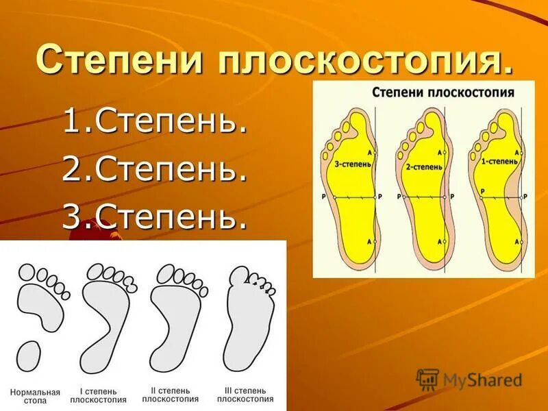 Поперечное 1 степени. Продольное плоскостопие 2 степени. Продольно-поперечное плоскостопие градусы. Плантография 3 степень плоскостопия. Степени плоскостопия сбоку.