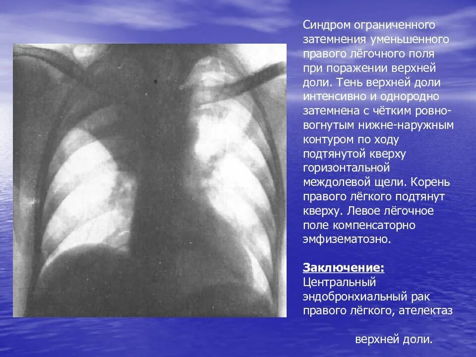 Затемнение верхней доли легкого. Синдром ограниченного затенения. Синдром ограниченного затемнения легочного. Затемнение верхней доли правого легкого. Затемнение легочного поля.