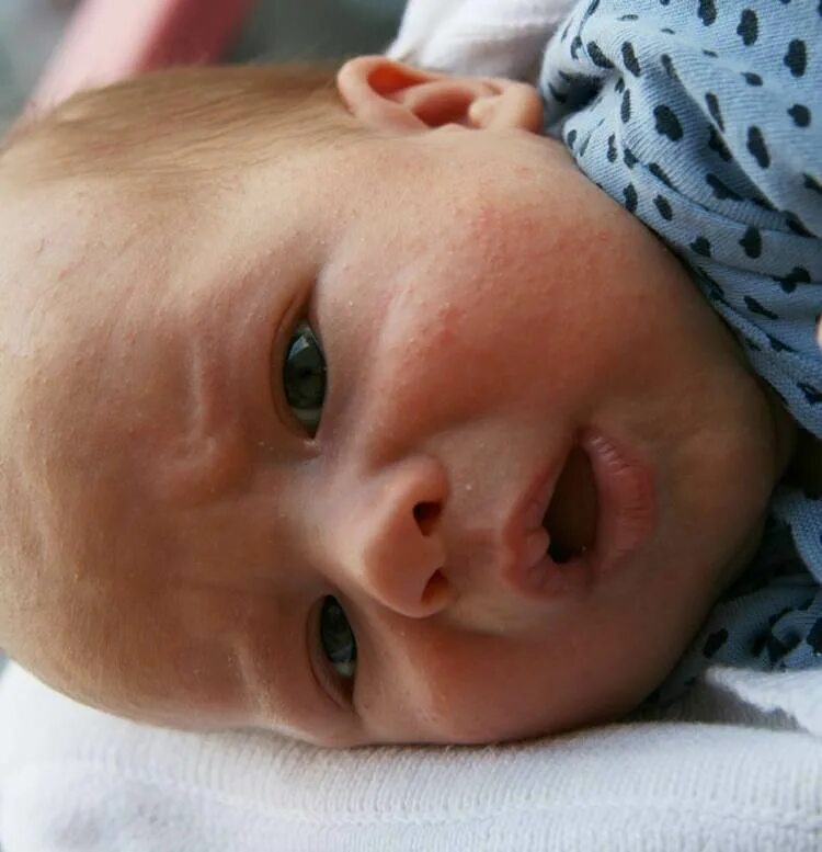 Аллергия у новорожденных. Аллергия у новорожденного ребенка. Диатезы новорожденных.