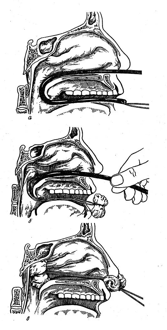 ватные турунды в носовые ходы вводят
