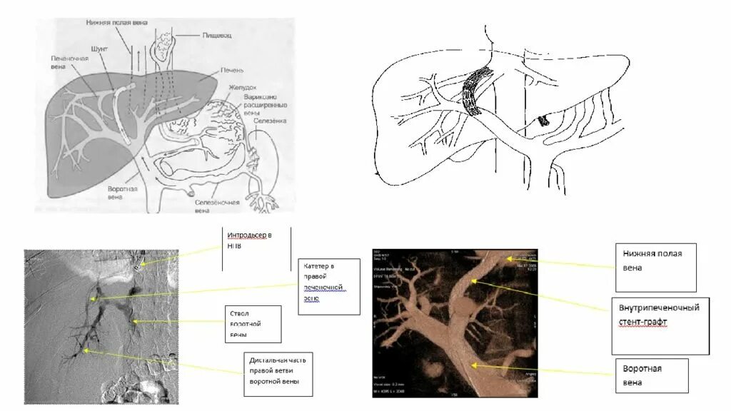Две нижних полых вены. Воротная Вена анатомия схема. Тромбоз воротной вены на кт. Ветви воротной вены кт.