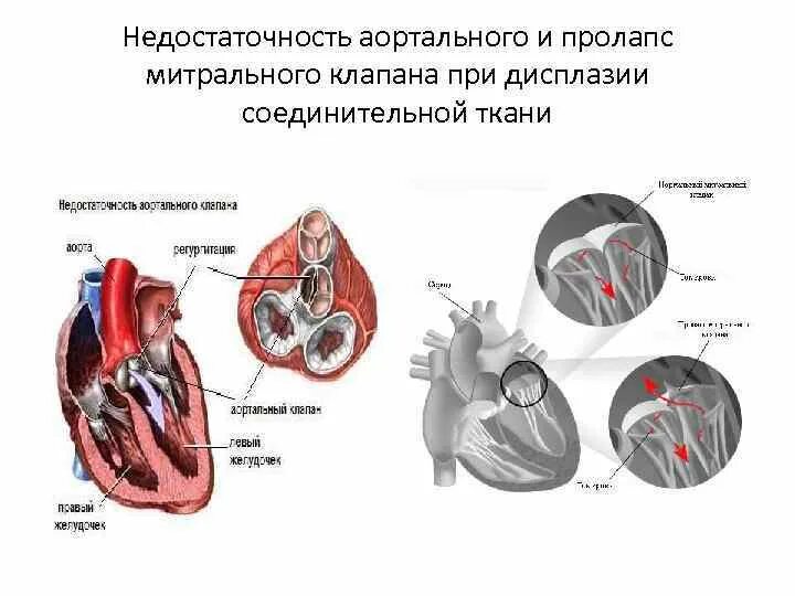 Что такое пролапс митрального клапана. Дисплазия митрального клапана сердца. ДСТ митрального клапана. Пролапс аортального клапана 1 степени. Дисплазия соединительной ткани митрального клапана.