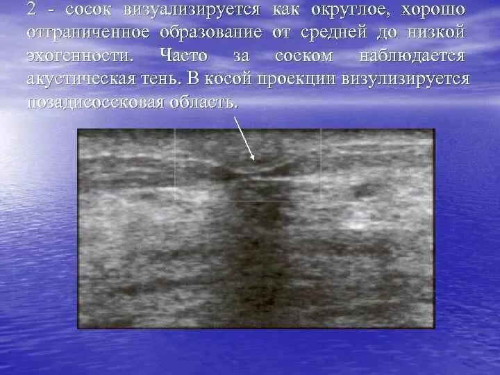 Гипоэхогенное округлое образование. Акустическая тень на УЗИ молочных желез что это. Дорсальная тень на УЗИ молочных желез. Акустические тени на УЗИ молочной железы что это. Акустическая тень на УЗИ.