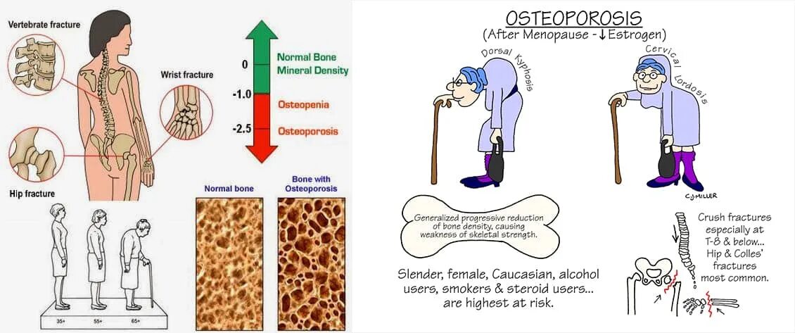 Какие анализы на остеопороз. Профилактика остеопороза. Профилактика остеопороза картинки. Остеопороз памятка. Остеопороз санбюллетень.