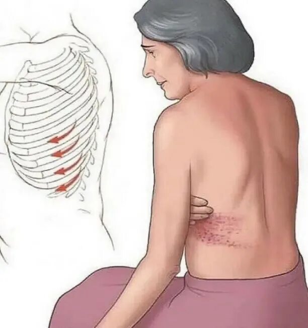 Опоясывающий герпес/постгерпетическая невралгия. Межреберная невралгия грудной клетки. Межреберная невралгия позвоночник. Невралгия симптомы грудного отдела. Невралгия отдает в молочные железы.