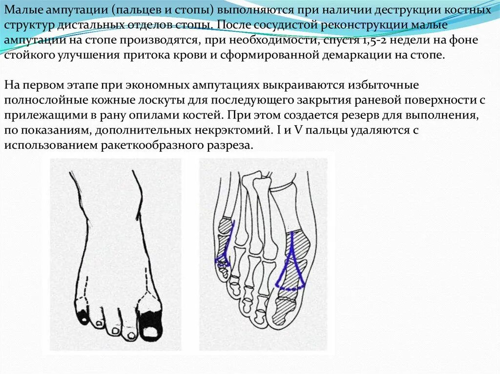 Локальный статус нижних конечностей. Синдром диабетической стопы некроз. Диабетическая стопа некроз 1 пальца. Ушиб голеностопного сустава карта вызова СМП. Диабетическая стопа ампутация.