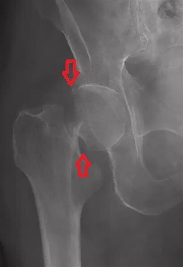 Трещина тазобедренного. Варусный перелом шейки бедра рентген. Рентген тазобедренного сустава перелом шейки бедра. Базисцервикальный перелом шейки бедра рентген. Перелом тазобедренного сустава рентген.