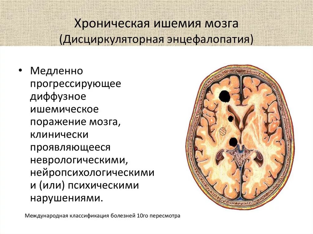 Хроническая болезнь мозга. Хроническая ишемия головного мозга. Дисциркуляторная энцефалопатия головного мозга. Иш имия головного мозга. Ишемическое поражение мозга.