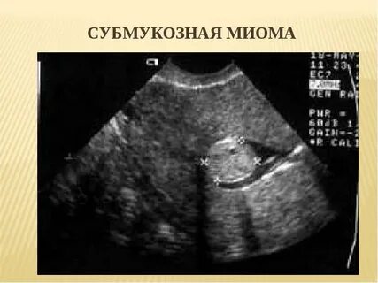 Миома матки при беременности 12 недель