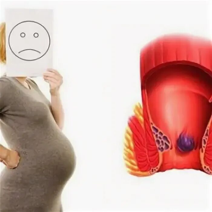 Геморрой у беременных фото. Геморрой 9 месяц беременности фото. Геморрой в беременность в 20 недель беременности фото. Геморрой во время беременности фото.