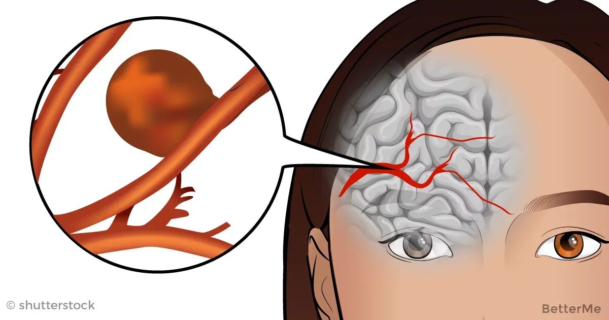 Микроаневризма сосудов головного. Аневризма сосудов мозга. Аневризма артерии головного мозга. Аневризмы сосудов головного мозга клиника. Расширение сосудов головы