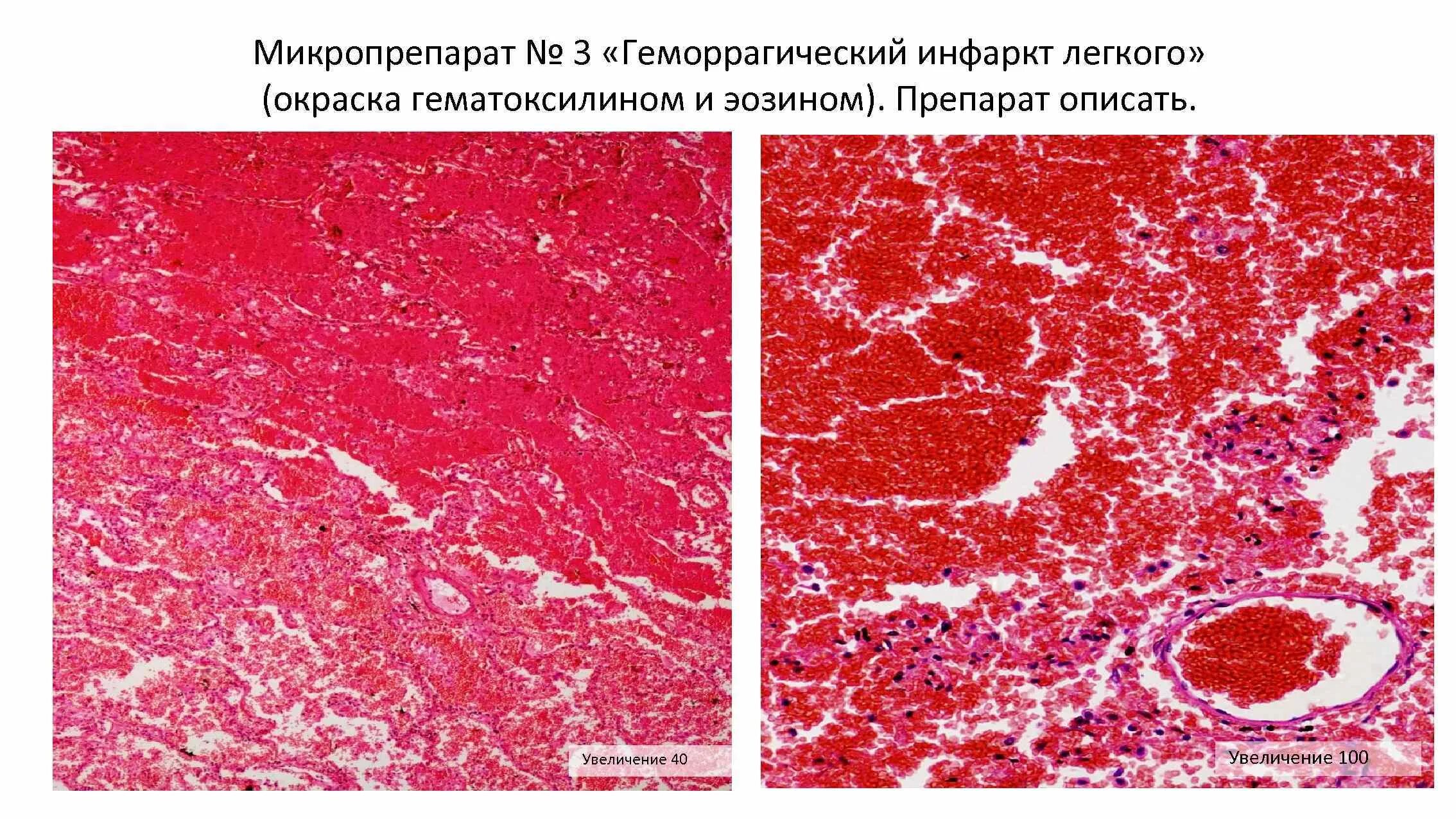Красный инфаркт легкого микропрепарат. Стаз сосудов патологическая анатомия. Инфаркт миокарда патологическая анатомия макропрепарат. Геморрагический инфаркт легкого патанатомия. Тромб в печени
