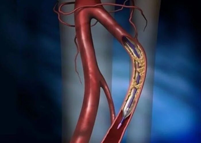 Стентирование видео. Стентирование коронарных артерий. Ангиопластика сосудов сердца. Ангиопластика сонной артерии. Стентирование сосудов сердца.