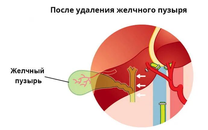 После удаления желчного пузыря. Синдром удаленного желчного. Постхолецистэктомический синдром (после удаления желчного пузыря);. После удаленного желчного пузыря. Синдром длинной культи пузырного протока.