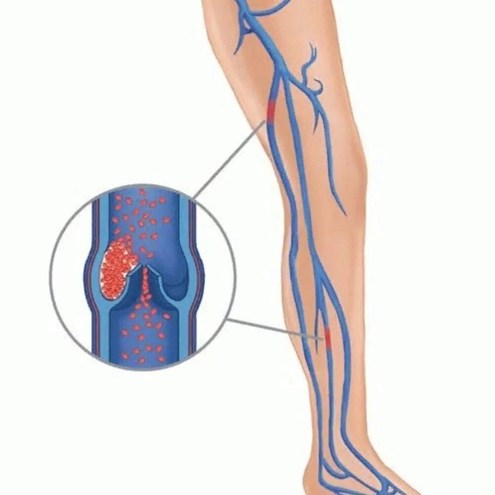 Сгусток в вене. Септический тромбофлебит. Варикозное расширение вен нижних конечностей. Венозный тромбоз глубоких вен нижних конечностей. Илеофеморальный тромбоз.