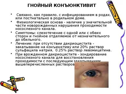 Коньюктивит это