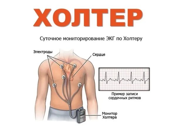 Сколько дней холтер. Холтеровское мониторирование электроды. экг по холтеру. суточное мониторирование экг (холтер). суточное мониторирование экг по холтеру схема.