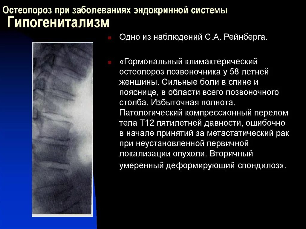Остеопороз тела позвонка кт. Остеопороз тел позвонков грудного отдела. Компрессионный перелом позвонка рентген остеопороз. Осложнения при остеопорозе. Остеопороз перелом позвонка.