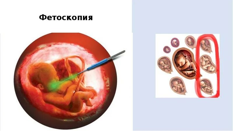 Фетоскопия хориона. Фетоскопия в пренатальной диагностике. Фетоскопия материал для исследования.