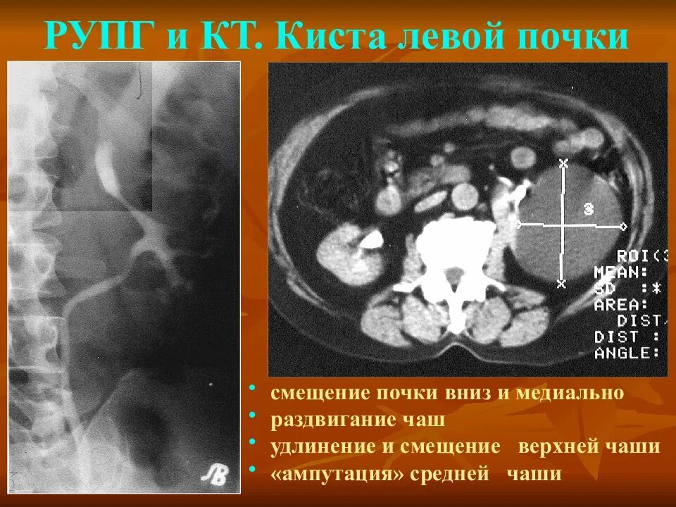 Киста в почке лечение у взрослых женщин. Многокамерная киста почки кт. Кортикальная киста левой почки.