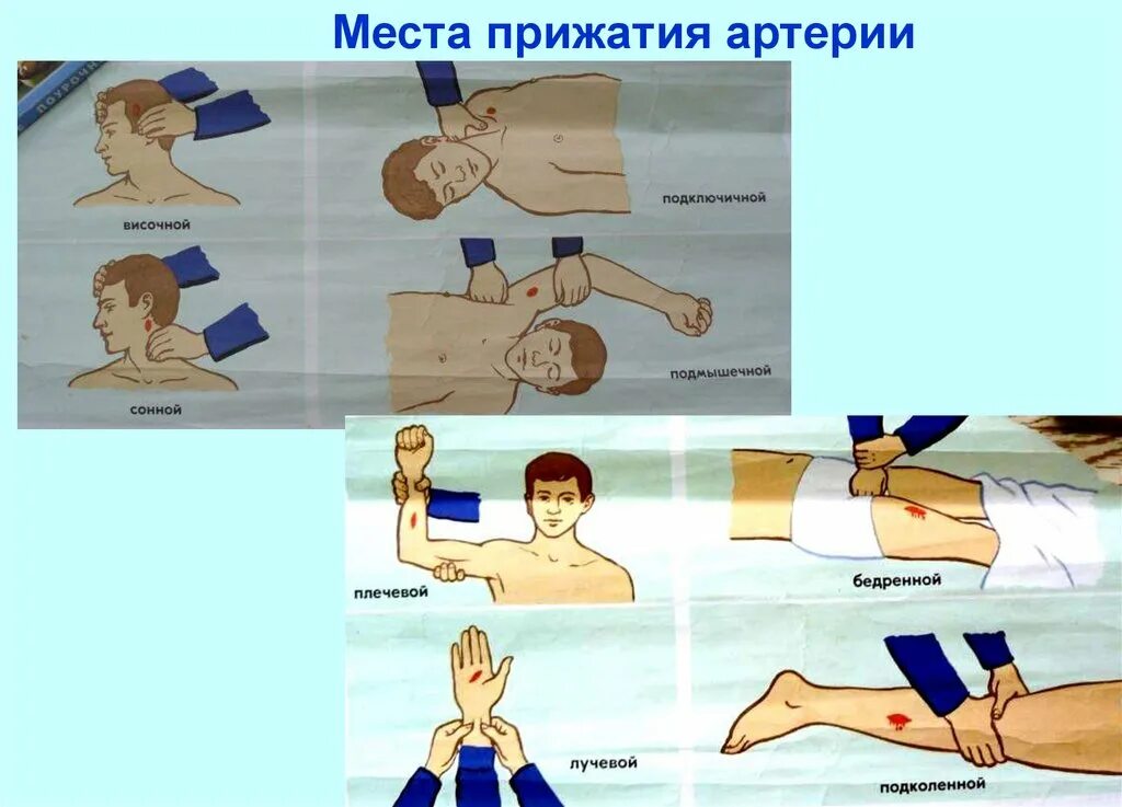 Прижатие бедренной артерии при кровотечении. Пальцевое прижатие артерий. места прижатия артерий. прижатие бедренной артерии.