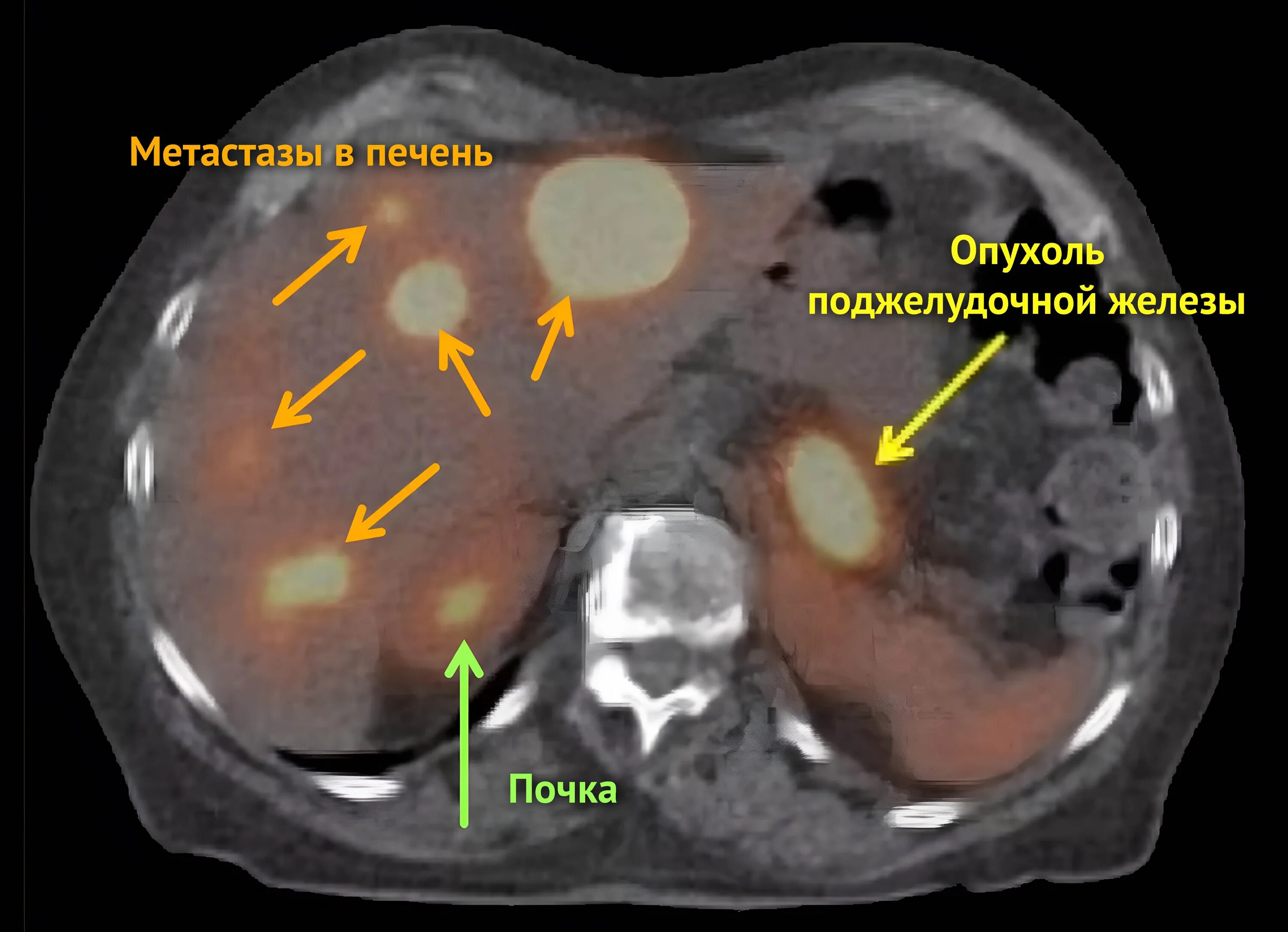 Метастазы в яичниках у мужчин. Опухоли и метастазы по кт.