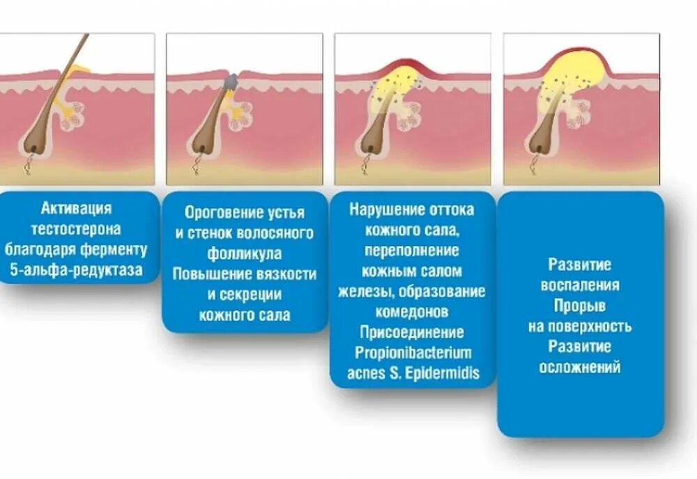 Этапы формирования акне.