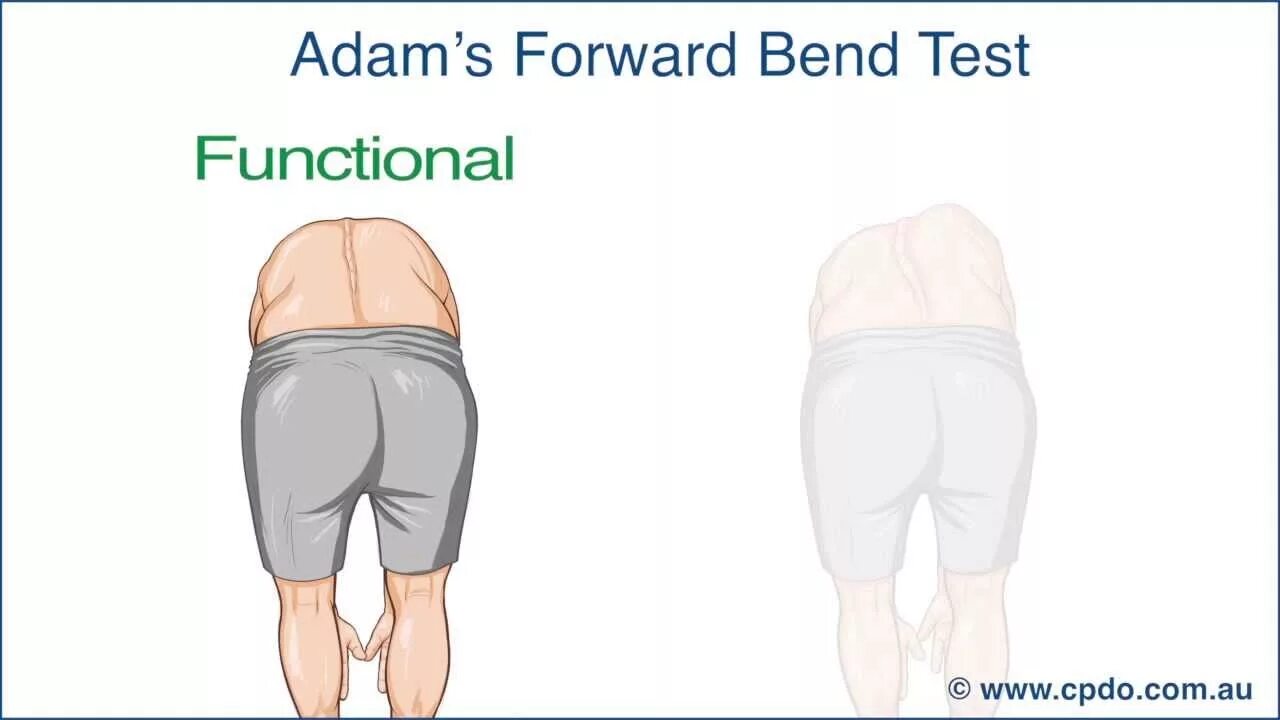 Adam test. Adams test. сколиоз тест адамса. тест адама на сколиоз.