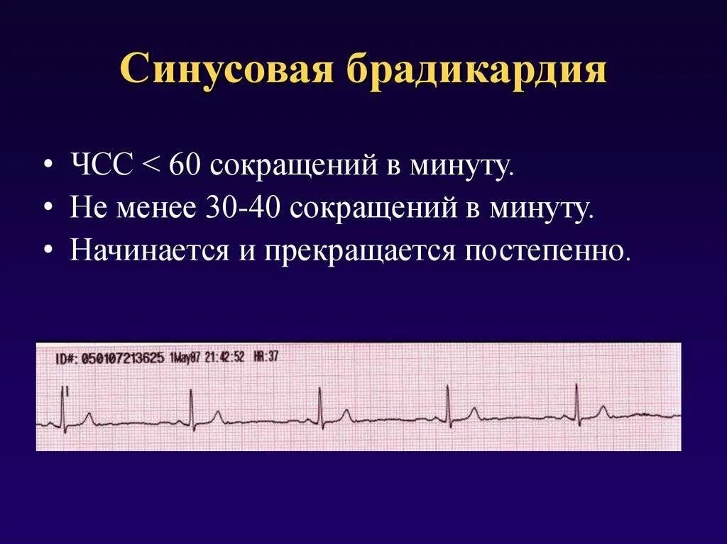 Синусовая аритмия 70 чсс. Синусовая брадикардия 802. экг при синусовой брадикардии сердца. синусовая брадикардия на экг. синусовая аритмия с чсс.
