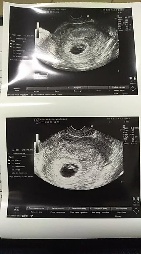 Как выглядит узи на 6 неделе. УЗИ 6 недель беременности. 6 Недель беременности ущиузи.