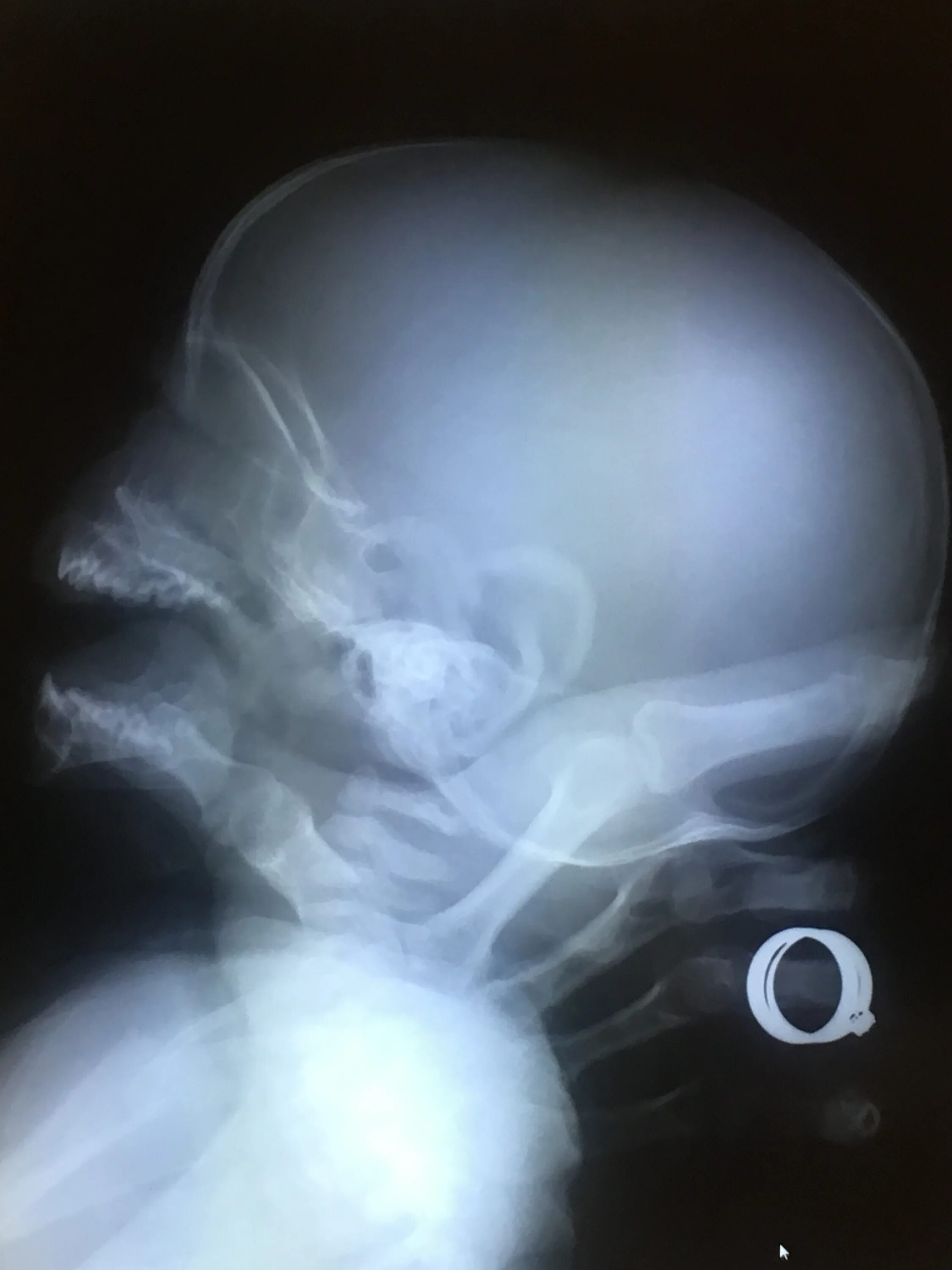 Трещина черепа у ребенка. Захождение костей черепа у новорожденных рентген. Талассемия рентген черепа. Рентгенограмма черепа ребенка. Перелом черепа у детей рентген.