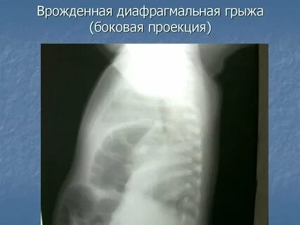 Грыжа легкого