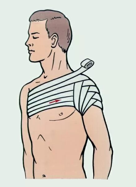 Техника наложения повязки на плечо. Колосовидная повязка. Колосовидная повязка на плечевой. Вывих плеча повязка колосовидная. Вывих плечевого сустава повязка.